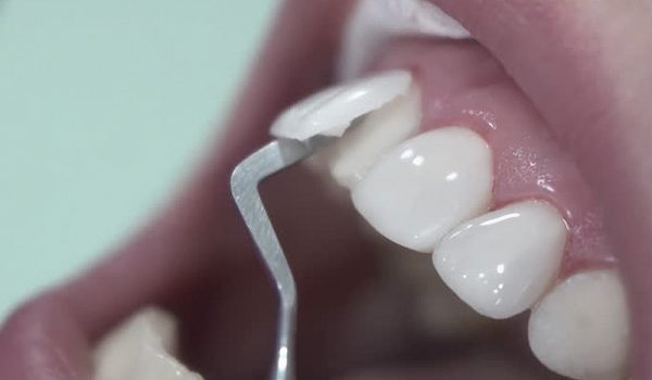 dental veneers, dentist, dental treatments