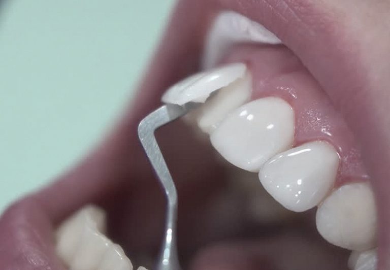 dental veneers, dentist, dental treatments