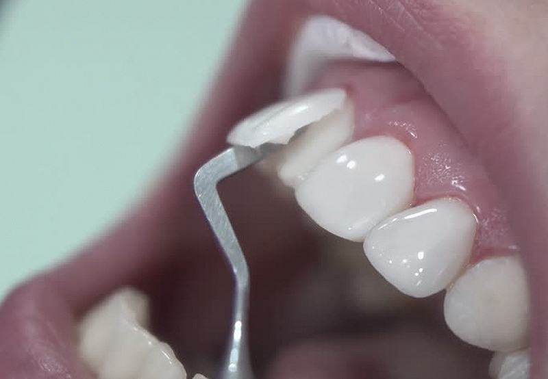 dental veneers, dentist, dental treatments