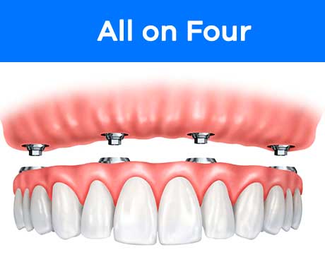 all-on-four-promo
