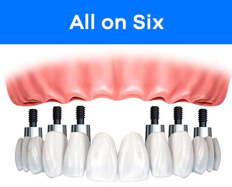 all-on-six-promo